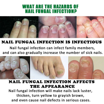 Ginger Nail Fungus Treatment Anti Fungal Foot Toenail Care Removal Repair Liquid